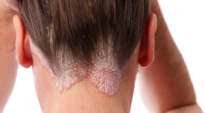 how to cure scalp psoriasis permanently