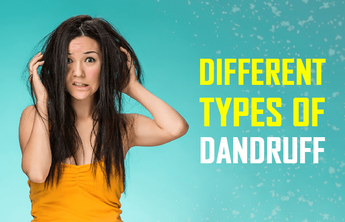 different types of dandruff and how to stop them