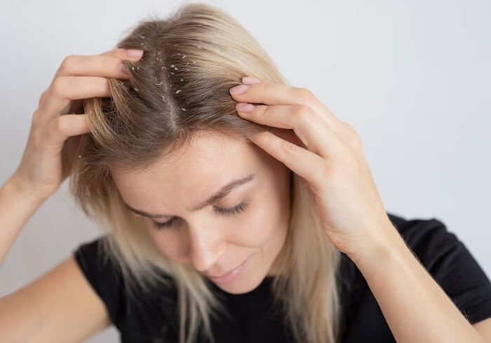 how to fix dry scalp around hairline
