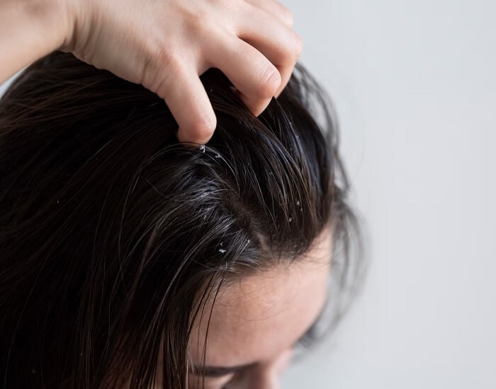 oily scalp dandruff treatment