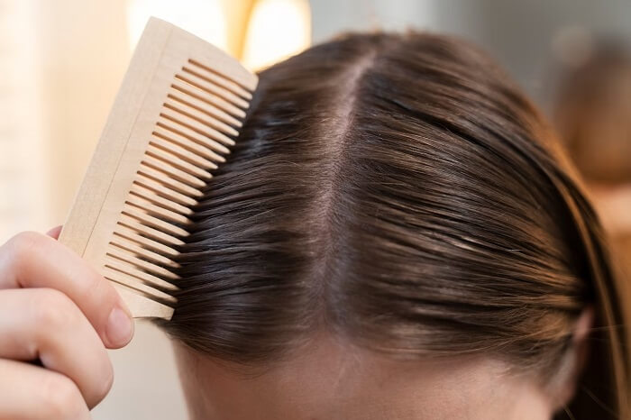 a woman suffering from a receding hairline problem